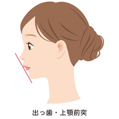 上顎突出の口元　出っ歯　Eライン　横顔 © koti