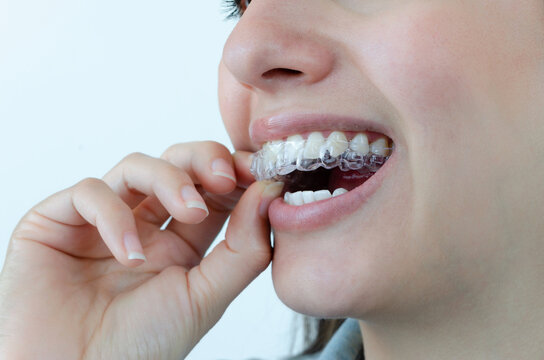 Mujer coloc&aacute;ndose alineadores dentales invisibles. Tratamiento de ortodoncia invisalign removible. 