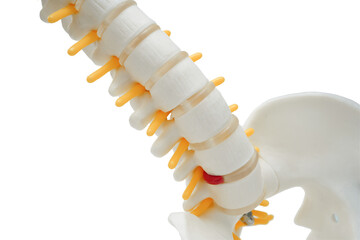 Fototapeta premium Spinal nerve and bone, Lumbar spine displaced herniated disc fragment, Model for treatment medical in the orthopedic department.
