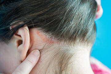 Close-up of irritated skin on the scalp behind the ear with redness and flaking, fingers pointing at the affected area, highlighting dermatological issues or skin conditions