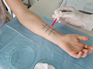 Skin allergy testing in a clinical setting with a patient receiving allergen solution concept