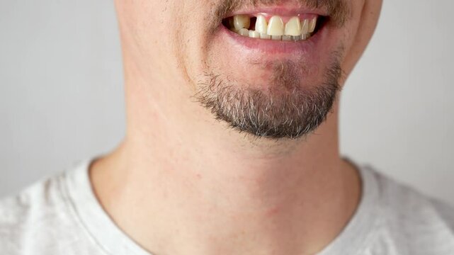 Close-up of a man mouth with missing tooth. Man after tooth extraction or tooth removal.