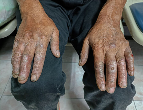 Conditions of the skin on the hand of leprosy patients which looks like blisters and the patient will have numbness. Wound of leprosy patient.