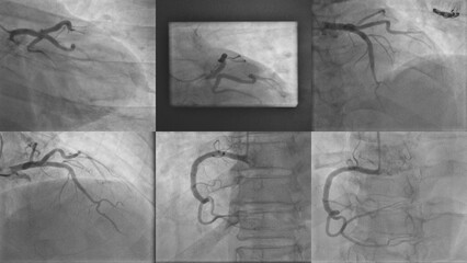 Coronary Angiogram: Medical X-Ray for Heart Disease Diagnosis, Identifying Coronary Artery Disease, Atherosclerosis, and Arterial Blockages for Accurate Cardiovascular Assessment