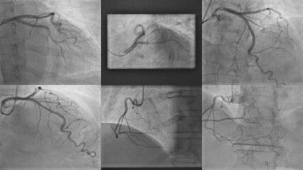 Comprehensive Angiogram Analysis of Heart Vessels: Detailed Evaluation of Coronary Arteries,...