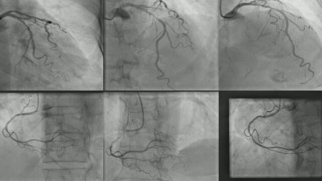 coronary angiogram showed right coronary artery (RCA) left anterior descending artery (LAD) and LCX