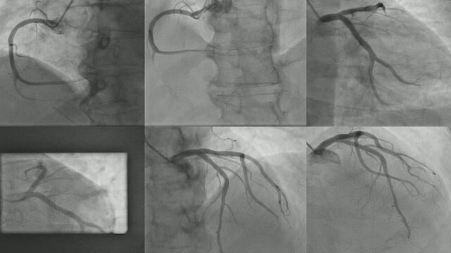 Normal coronary angiogram of left and right coronary artery during cardiac catheterization.