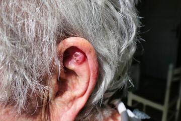 Basal Cell Carcinoma of the skin located inside the ear lobe necessitating the need for an...