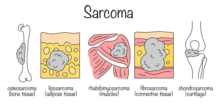 Sarcoma