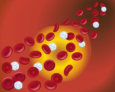 Healthy human red and white blood cells in an artery. Cholesterol plaque in artery. Accumulation of cholesterol in blood vessels. Atherosclerotic plaque. Medical poster. Vector 3d illustration.