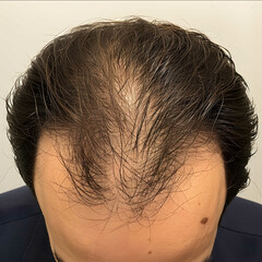 Hair loss picture from the front