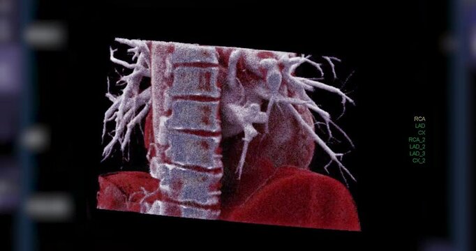 Realistic 3D Heart CTA Scan: A detailed CTA scan showing the coronary arteries and heart structure, providing a comprehensive view for clinical evaluation.