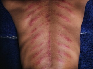 Naklejka premium The red back is scraped using a coin and massage oil. Kerokan is a tradition in Indonesia to cure colds