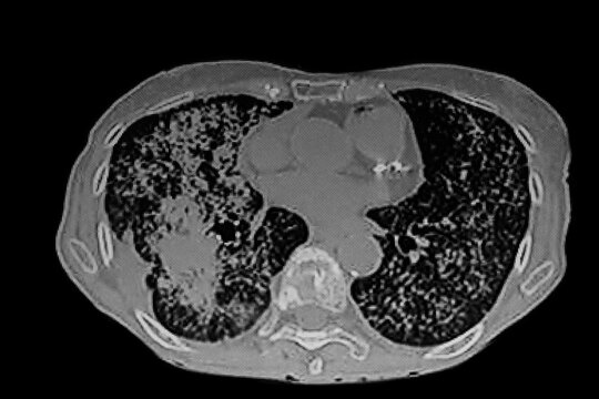 Medical themes: Chest CT Scan of lung cancer (Adenocarcinoma) with  miliary pattern.