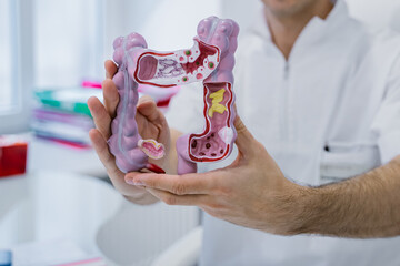 Male colon surgeon holding anatomical model for diagnosis and treatment in hospital, intestinal diseases, stomach ulcers and intestinal modia