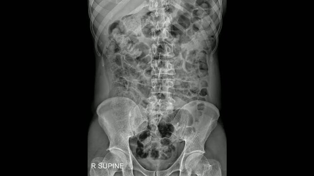 Abdomen X-Ray Showing Obstruction - Diagnostic Imaging for Gastrointestinal Conditions