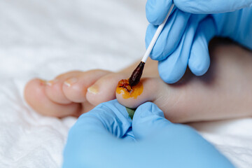 A doctor applies iodine to a woman's damaged nail.