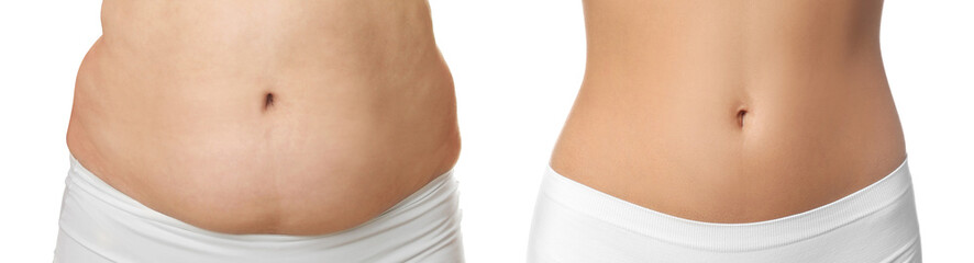 Woman showing her belly with excess fat on one side and slim on other, closeup. Collage with photos...