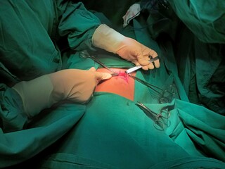 Appendix specimen from appendectomy, after surgery from the doctor.	

