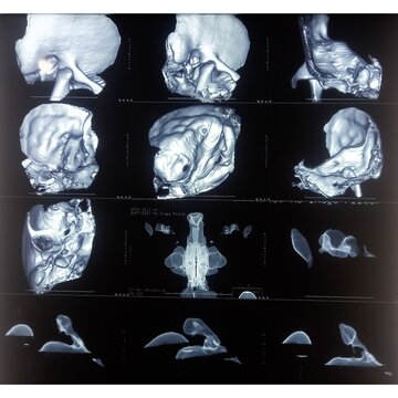 CT scan of the temporal bones showing soft tissue density lesion at bilateral middle ear and mastoid aircells. Inflammatory granulation tissue.