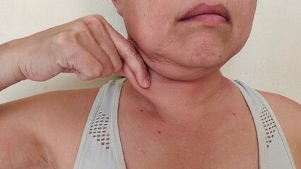 portrait the fingers holding the flabbiness adipose sagging skin under the chin, neck wattle and cellulite, Flabby skin and loose under the neck of the woman, health care and beauty concept.