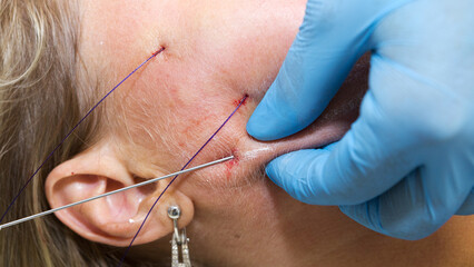 Close-up anti-age facial lifting procedure using PDO threads of polylactic acid applied in the face with aseptic cannula before extending skin