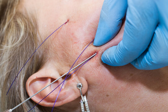 Close-up anti-age facial lifting procedure using PDO threads of polylactic acid applied in the face with aseptic cannula before extending skin