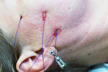 Close-up anti-age facial lifting procedure using PDO threads of polylactic acid applied in the face with aseptic cannula before extending skin