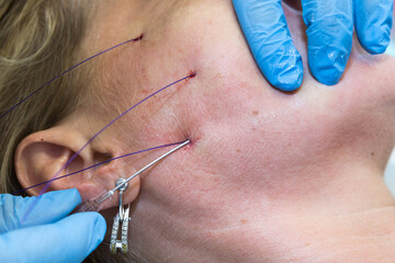 Close-up anti-age facial lifting procedure using PDO threads of polylactic acid applied in the face with aseptic cannula before extending skin