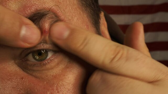 Adult man and skin problems. Acne.