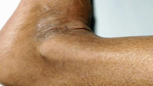 A close-up view of the skin on the feet of diabetics shows cracks accompanied by discoloration which may be edema, which indicates potential complications of diabetes.

