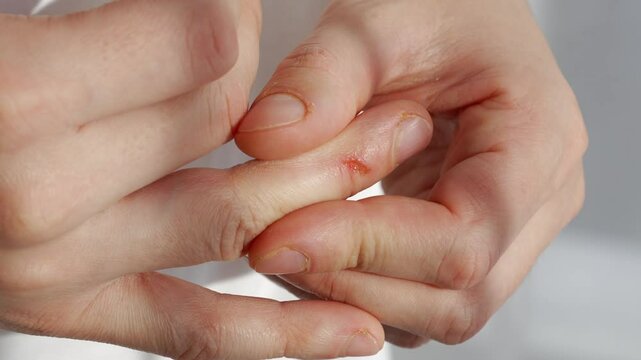 A cut on a man's finger.
The man scratched his hand.
The guy has a sore finger.
A man has a deep wound on his arm.
Wound infection and inflammation at the scratch site