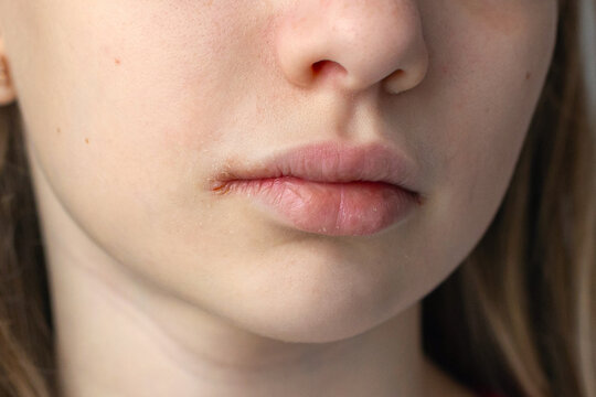 Close-up of chapped lips with corner irritation. Detailed close-up of a young persons chapped lips with visible irritation and dryness near the mouth corner, highlighting skin issues.