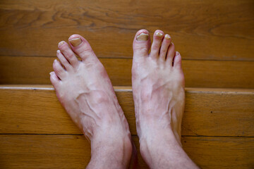 Micose com infecção fúngica nas unhas dos dois pés. © GeorgeVieiraSilva