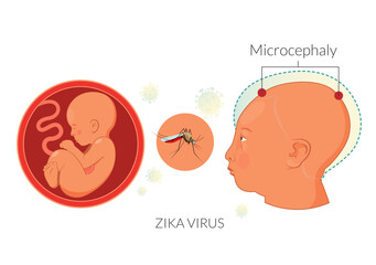 Zika Virus risk during Pregnancy  - Stock Illustration