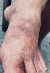 Varicose veins on feet caused by prolonged work hours. Image shows swollen veins on the feet due to standing or physical strain. Suitable for research on vein health and occupational impacts