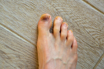 Runner's Feet: Black Toenails from Athletic Trauma. Barefoot Athlete's Feet Displaying Common Sports Injury