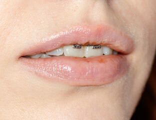 Naklejka premium A woman's mouth with braces and a silver colored metal band