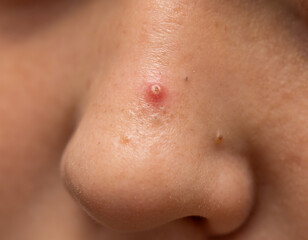 A woman has a red bump on her nose