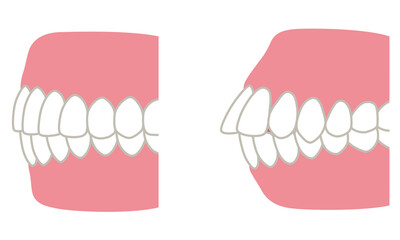 キレイな歯並びと、歯が出た歯並び　口ゴボ　歯列矯正 © koti