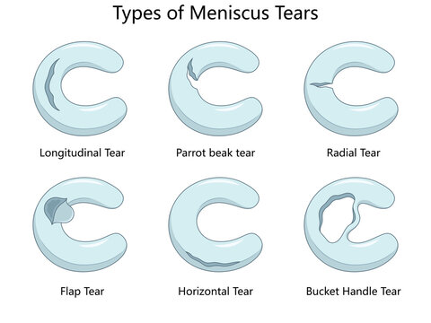 meniscus tears, including longitudinal, radial, parrot beak, flap, horizontal, and bucket handle tears diagram hand drawn schematic raster illustration. Medical science educational illustration