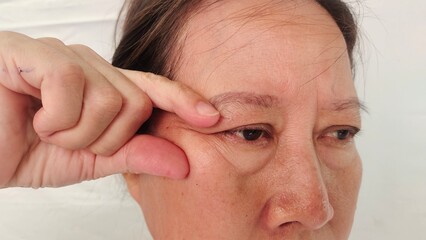 close up the fingers holding the wrinkle and Flabby skin beside the eyelid, swelling and ptosis, Flabbiness and loose, scar and freckles on the face of the woman, health care and beauty concept.