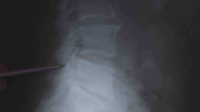 Doctor learn X-ray scan of intervertebral discs in spine. Close up.