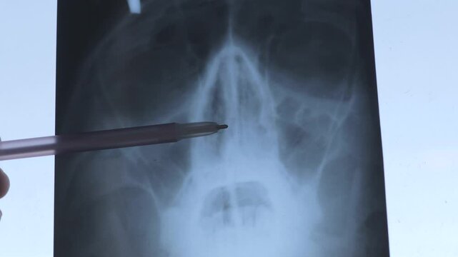 Doctor learning X-ray scan of a human skull. Deviated septum. Nasal septum, bone and cartilage that divide the nose in the middle is crooked. Breathing through the nose difficult, smell affected.