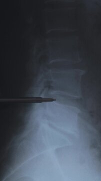 Doctor learn vertical X-ray scan of intervertebral discs in spine. Close up.