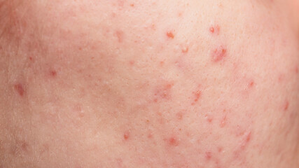 Many pimples. Bad skin. Hormonal acne, puberty. Skin acne background. Closeup acne pimple. Treatment for acne skin. Problem skincare. Pimples, pores, scars. Skincare treatment.