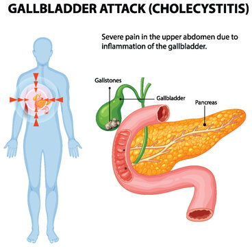 Understanding Gallbladder Attack and Cholecystitis