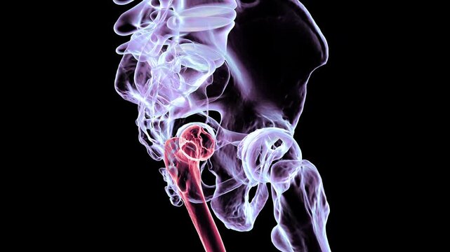 3D animation of human hip bones showing Legg-Calve-Perthes disease, a childhood condition where blood supply loss causes femoral head degeneration.