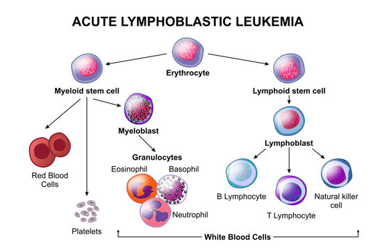 Acute Lymphoblastic Leukemia cancer cell Illustration