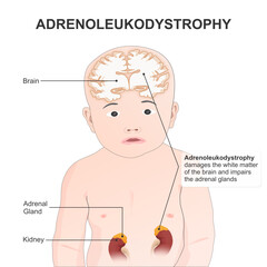 Fototapeta premium Adrenoleukodystrophy (ALD) illustration genetic disease
